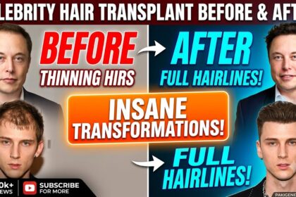 Celebrity Hair Transplant Before and After